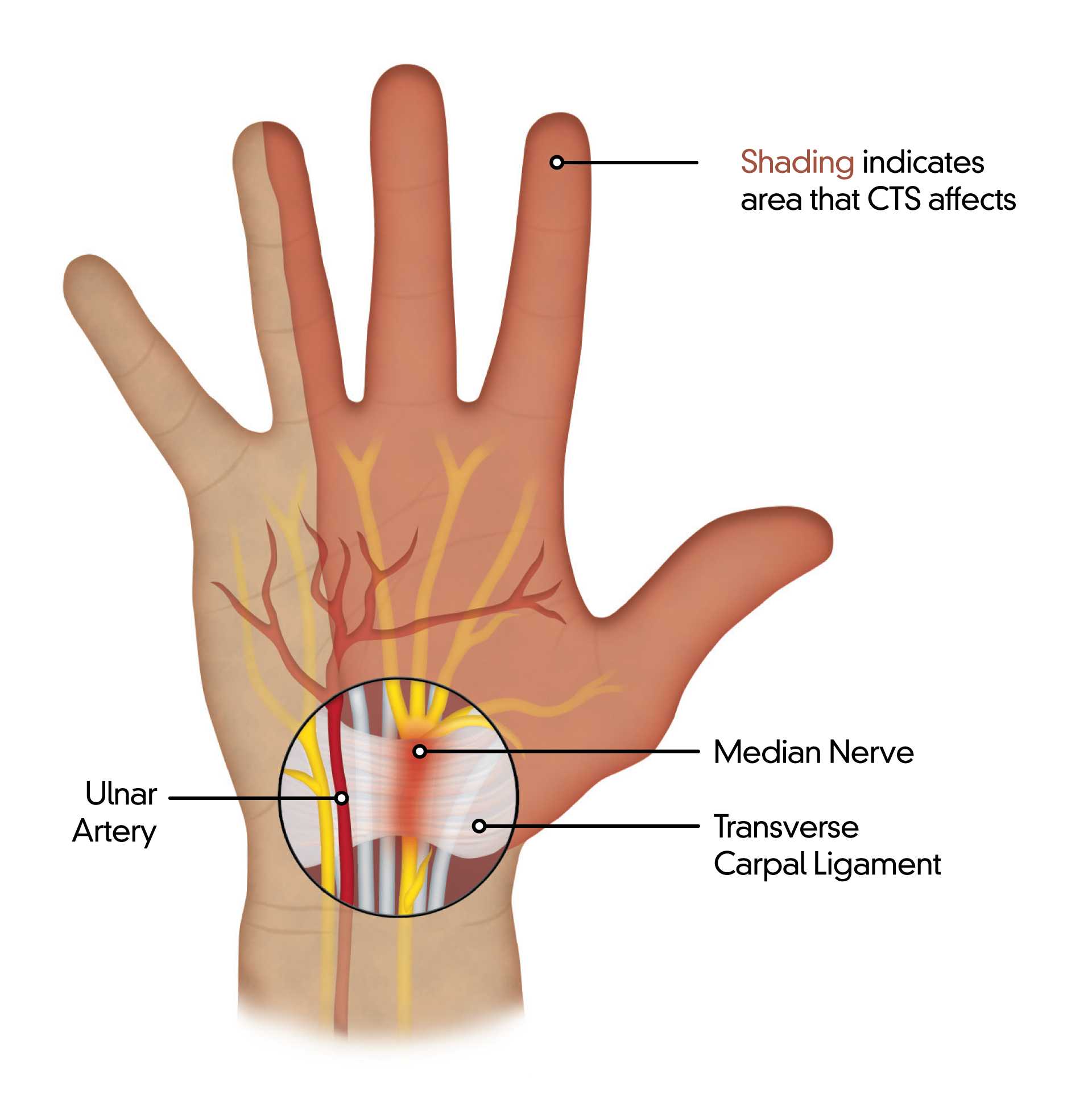 When To Consider Surgery: 4 Exercises For Carpal Tunnel Syndrome