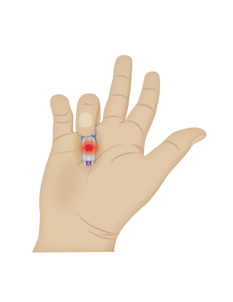 Trigger finger A0 pully showing where pain radiates from.