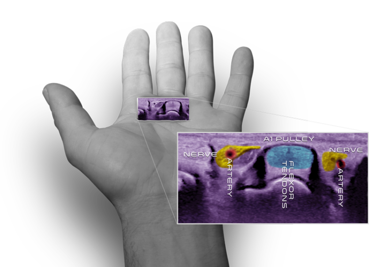 Cross section of trigger finger anatomy under ultrasound
