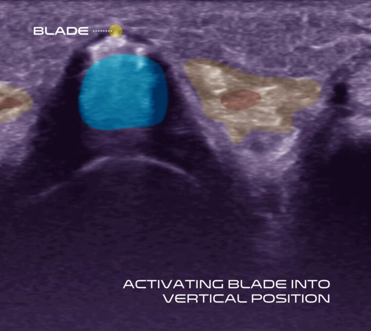 Activating blade into vertical position under ultrasound