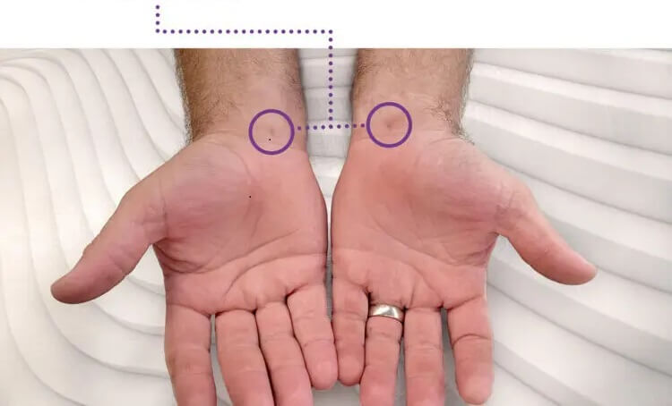 Two open hands highlighting a 2mm incision on both wrists from a bilateral carpal tunnel release using ultrasound guidance.
